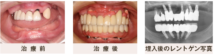 インプラント症例