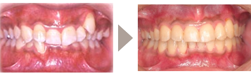 歯科矯正1