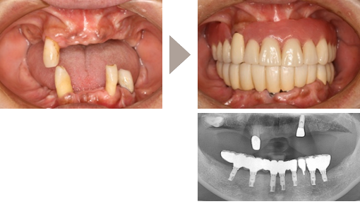 インプラント症例1