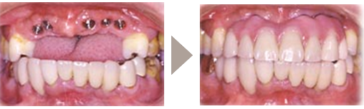 インプラント症例4